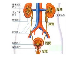 膀胱结石有什么症状？