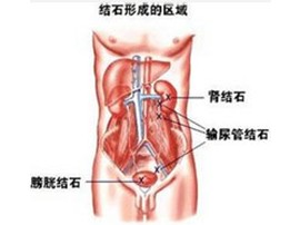 输尿管结石的症状